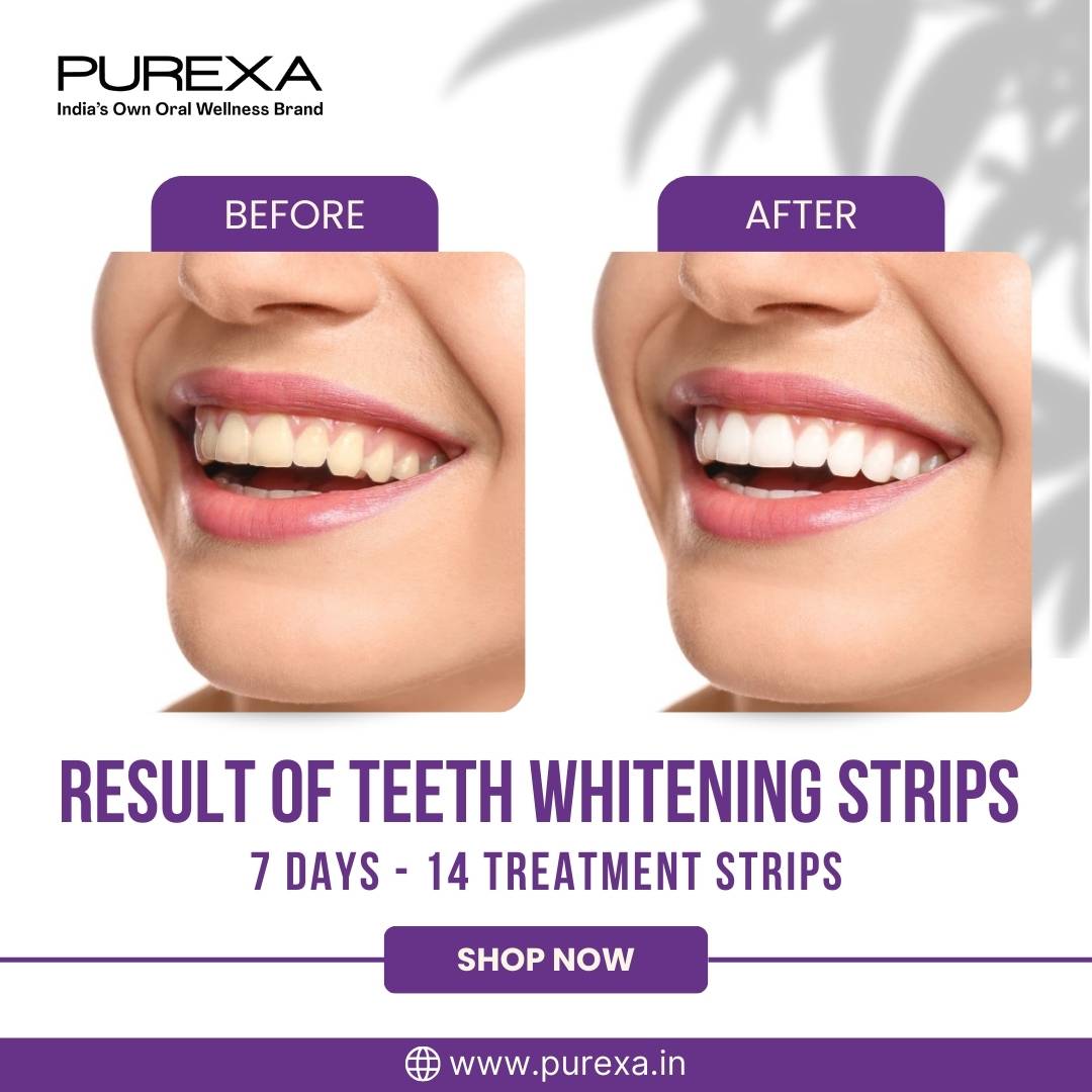 Teeth Whitening Strips and Teeth Whitening Pen (Teeth Whitening Kit)
